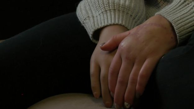 Hombre cortó las manos de su pareja con un hacha en Rusia: 